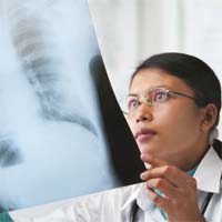 Treating Mesothelioma-Related Lung Fluid Build-Up