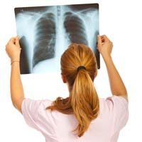 Can Chest X-rays Help Prevent Mesothelioma?