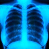 Drop in Lung Volume Predicts Poor Mesothelioma Outcome