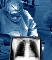 Mesothelioma Survival Improved by Adding Heated Chemotherapy to Surgery