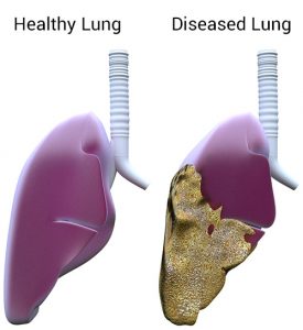 Pleural Mesothelioma Affects on Lungs