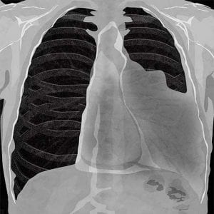 Diagnosed Mesothelioma Imaging Scans