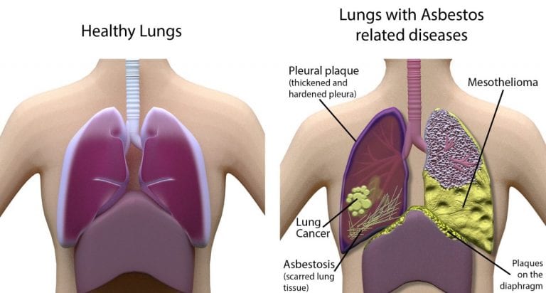 Mesothelioma: How Has Paul Kraus Survived For Over 20 Years?