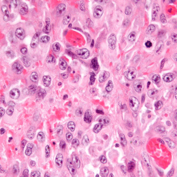 Mesothelioma Tumors Thrive in Low Oxygen Environment