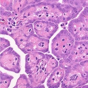 sarcomatoid mesothelioma