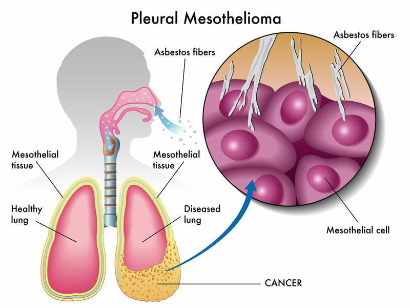 1. What is mesothelioma and its symptoms?