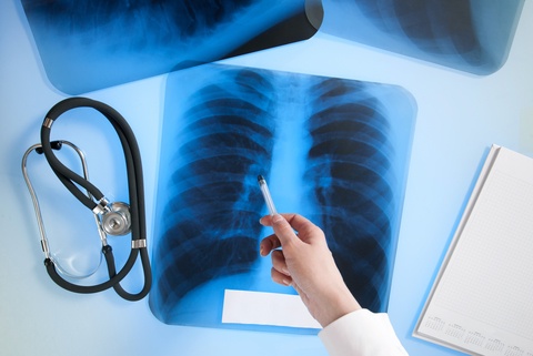 Early Detection Matters: The Role of Hydropneumothorax in Diagnosing Mesothelioma